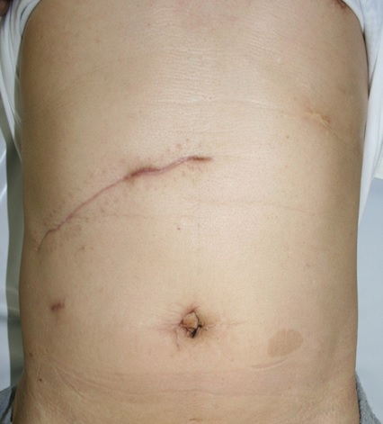 写真3．開腹手術（胆嚢摘出術）