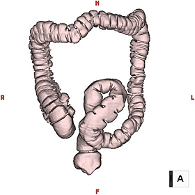 大腸の形状を観察するためのVR画像