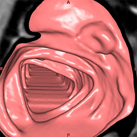 大腸カメラの様に観察できるVE（仮想内視鏡）画像